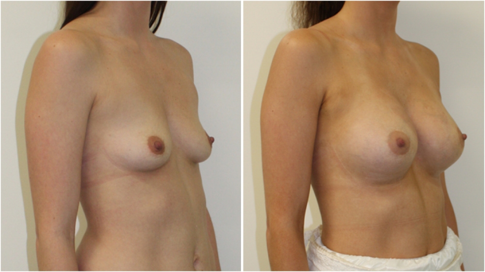 Enhanced-style look achieved by Dr Miroshnik with the use of 360g, extra high profile implants.