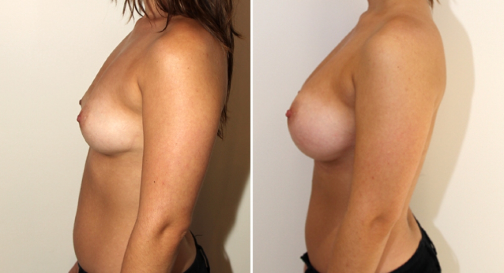 Enhanced style look created by Dr Miroshnik using 390g, high profile, round style, gel implants, subfascial placement.