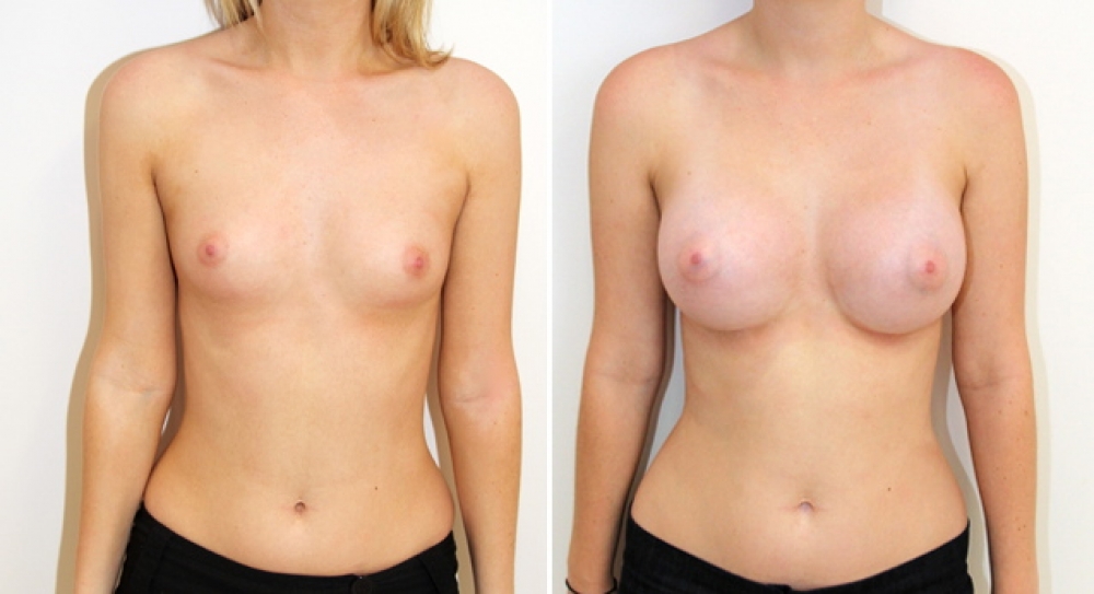 Natural style breast augmentation by Dr Miroshnik using 390g, high profile, round implants, dual plane placement