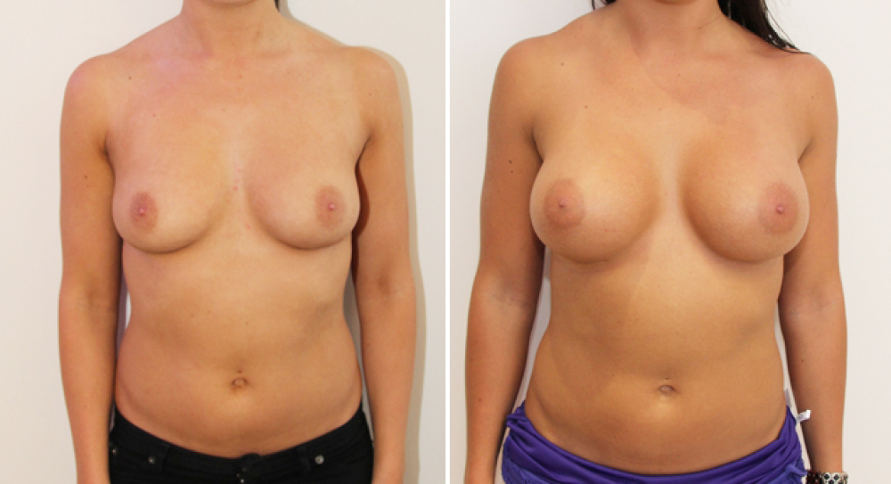 Enhanced style look achieved here with 425g, high profile, anatomical P-URE implants.