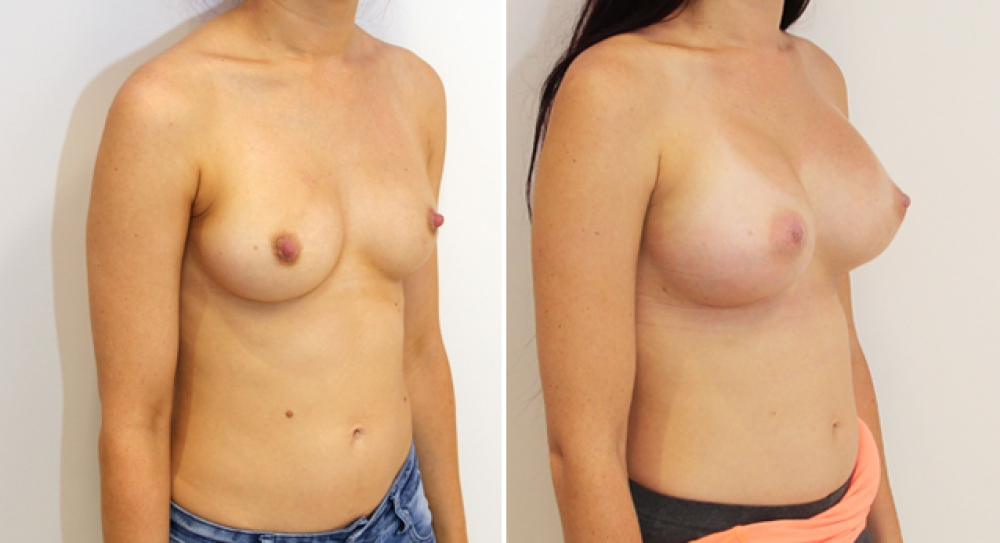 Enhanced style augmentation created by Dr Miroshnik with 470g, extra high profile anatomical implants.