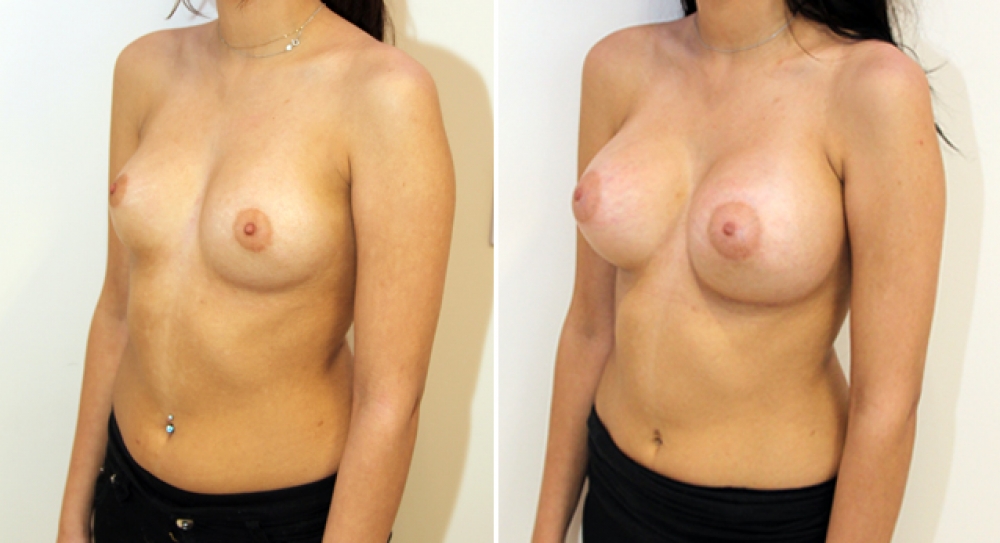 Enhanced look created here with the use of high profile, 345g round style implants.