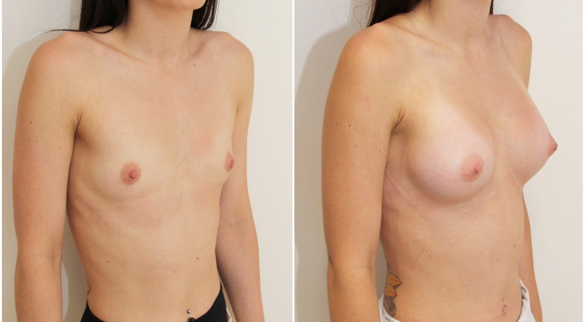 Anatomical implants combined with dual-plane positioning is Dr M's favourite way of creating naturally shaped, youthful breasts when starting with almost nothing (AA cup).
