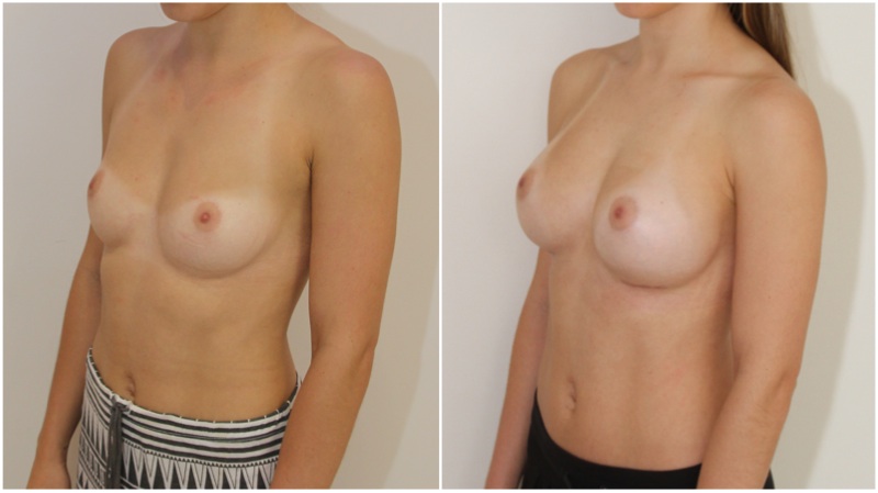 Natural-style augmentation by Dr M using 275g, moderate profile anatomics