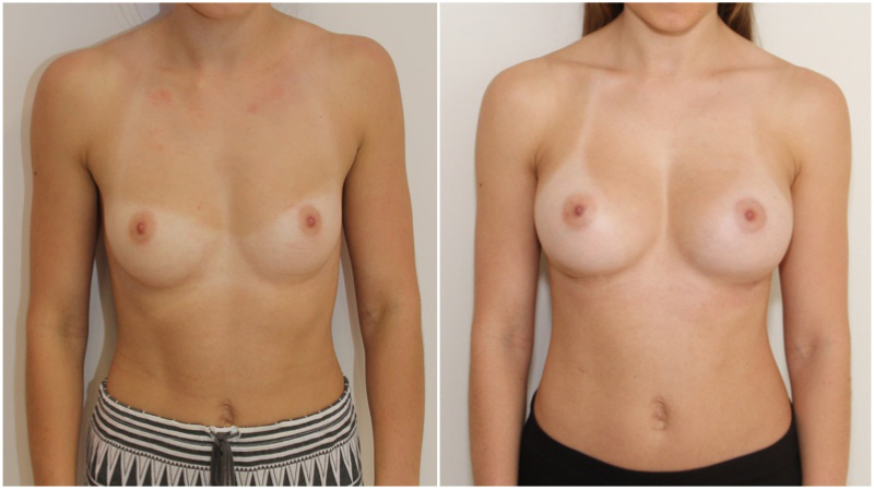 Natural-style augmentation by Dr M using 275g, moderate profile anatomics