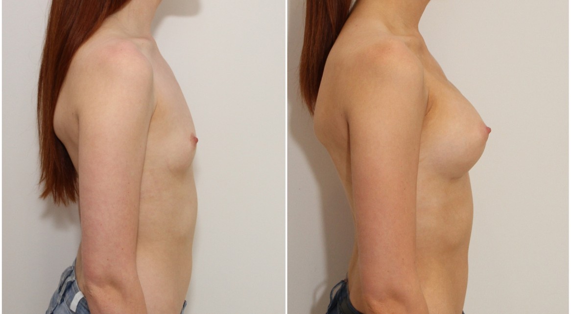 Natural style augmentation by Dr M with dual plane positioned 315g anatomics.