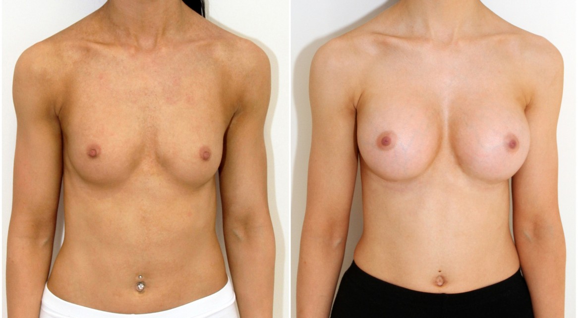 Natural style augmentation by Dr M with 330cc anatomics, dual plane.