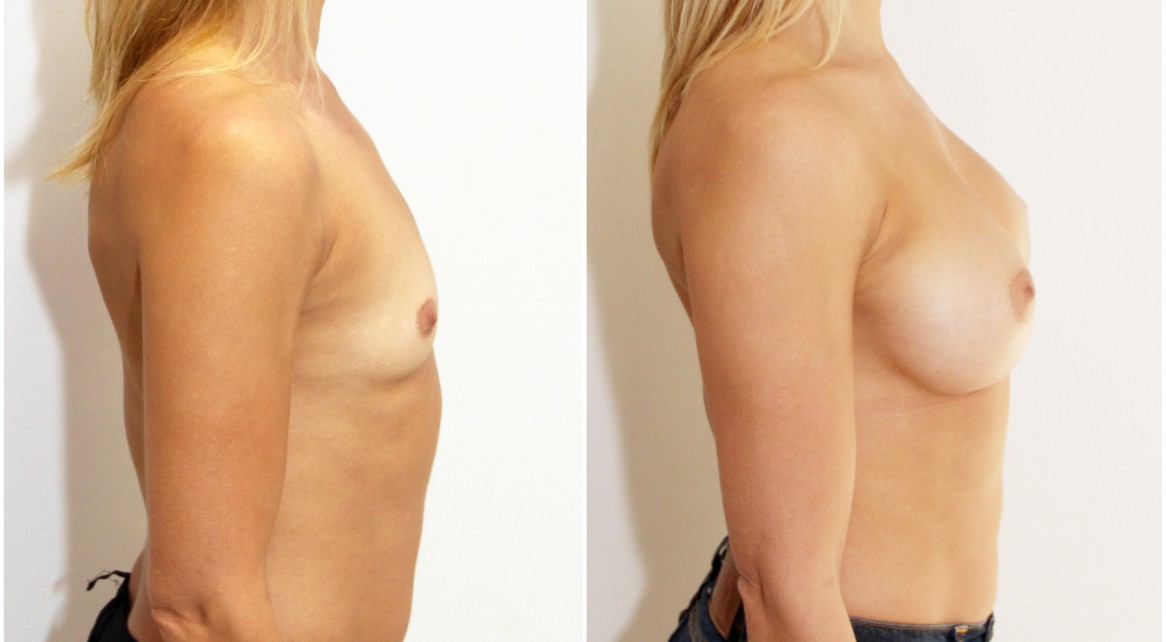 Natural style augmentation by Dr M with 330cc, dual plane anatomics.
