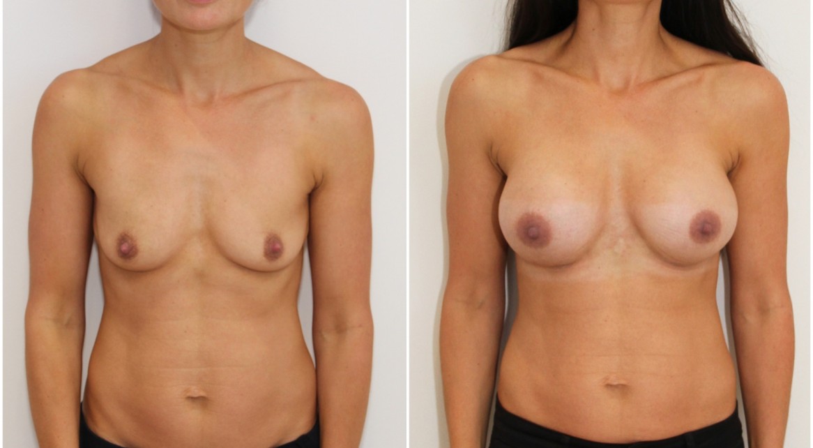 Natural style augmentation by Dr M with 330cc, anatomical, mod + profile, dual plane positioned implants.