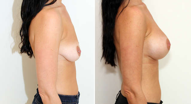 Droop (ptosis) correction without lift surgery using 375cc, highly cohesive gel anatomical implants.