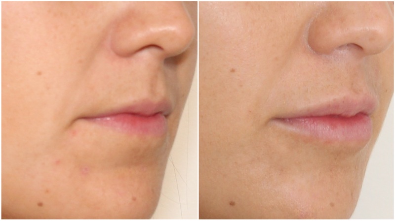 Subtle lip enhancement achieved using hydrating lip filler