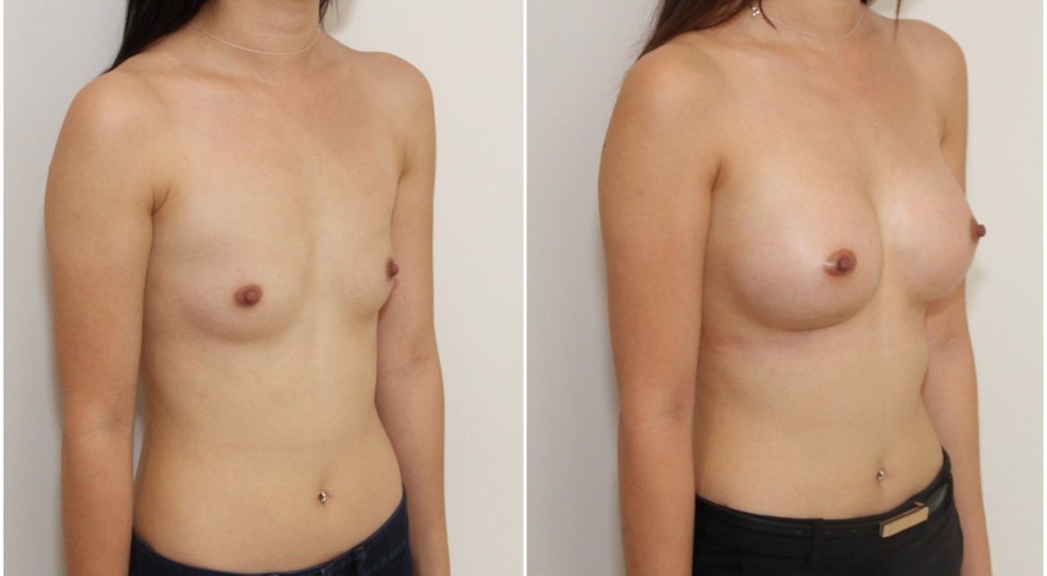 AA cup, natural shape created with 245g anatomical implants, dual plane positioned.