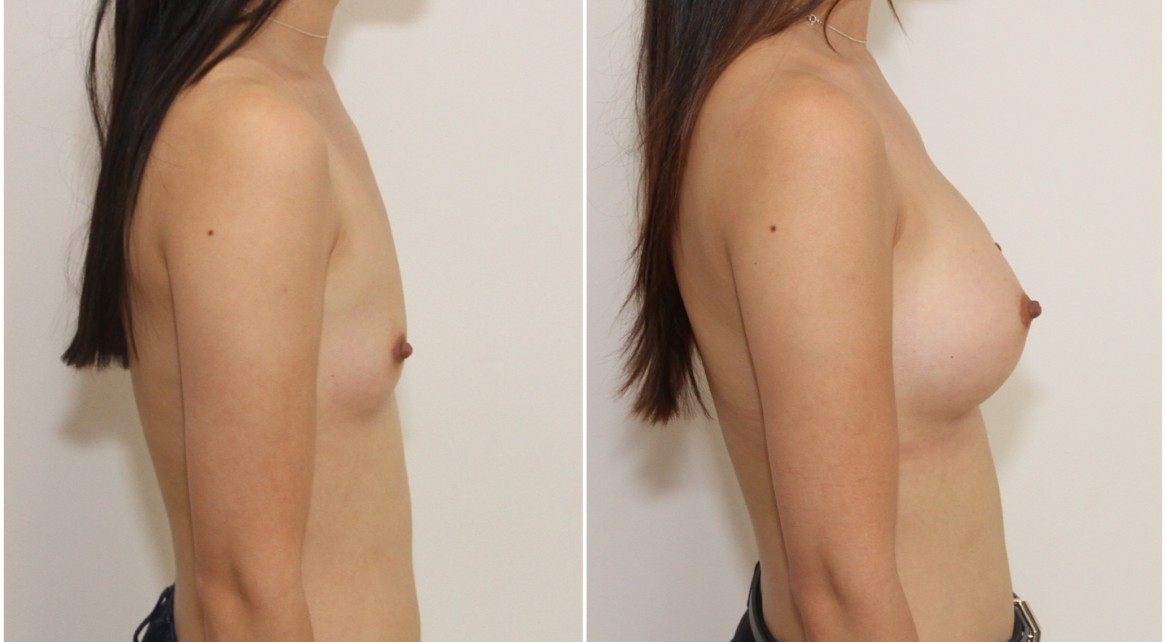AA cup, natural shape created with 245g anatomical implants, dual plane positioned.