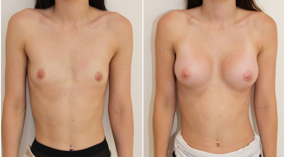 AA cup, minimal breast volume to start with, shape created with 255cc CPG memory gel, dual plane positioned anatomical implants.