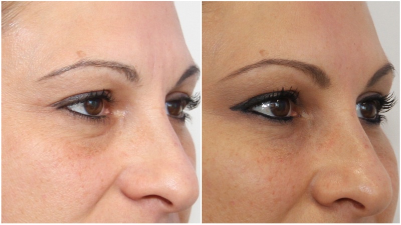Softening under eye hollows using hydrating dermal fillers