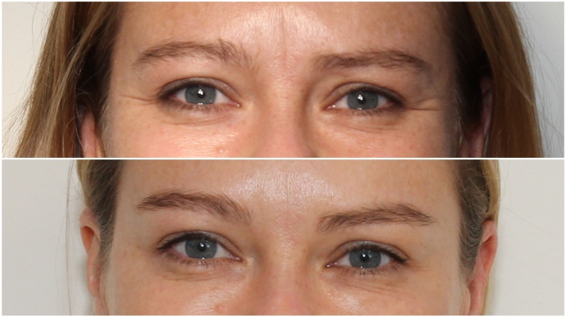 Softening under eye hollows using hydrating dermal filler