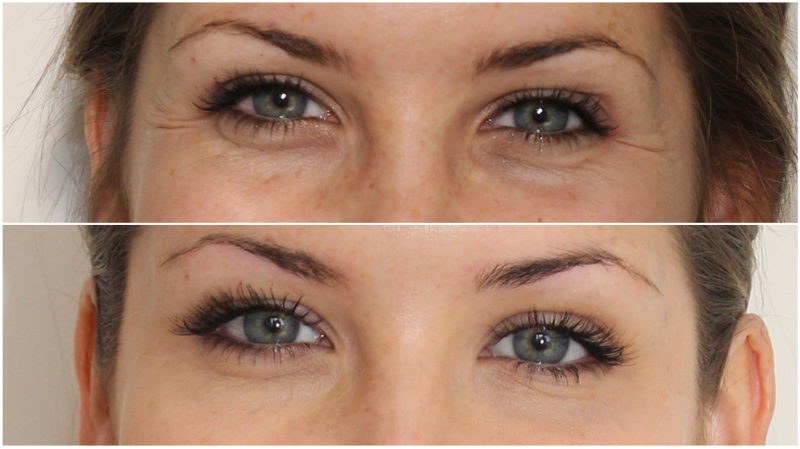 Softening under eye hollows using hydrating dermal filler in combination with anti-wrinkle injections