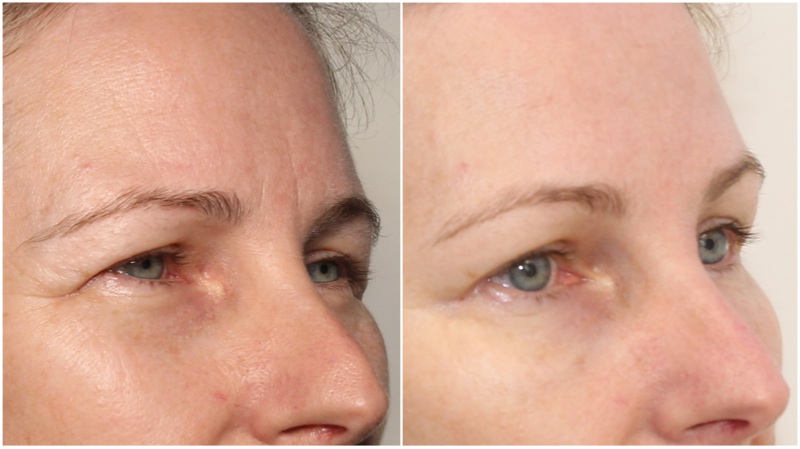 Hydrating filler used to soften under eye hollows. Anti-wrinkle injections have also been used to complete the rejuvenation