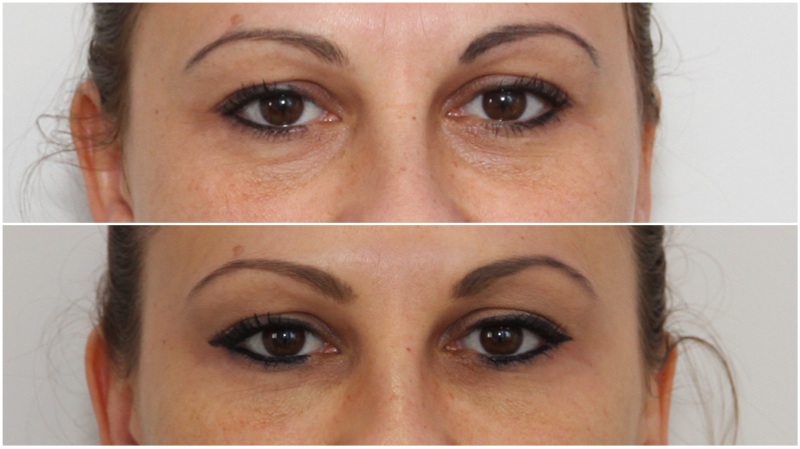 Softening under eye hollows using hydrating dermal filler
