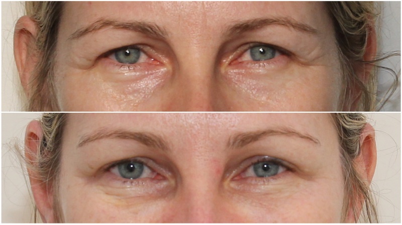 Hydrating filler used to soften under eye hollows. Anti-wrinkle injections have also been used to complete the rejuvenation