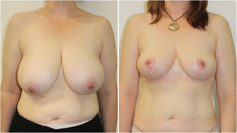 Late 40s, no children, vertical short-scar breast reduction and lift with nipple repositioning and reshaping. Approximately 250g tissue removed from each breast, DD -> C cup.