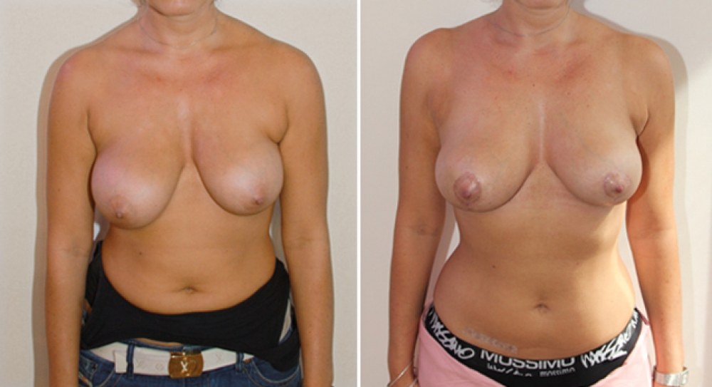 Mid 20's, no children, bilateral breast reduction with areolar reshaping performed with 40g of breast tissue removed from right breast and 23g from left breast, to correct symmetry and shape.