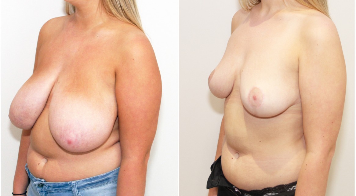 Early 20s, no children, bilateral breast reduction, reshape and lift with removal of 600g of breast tissue per side.